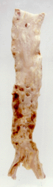 mildly atheromatous aorta