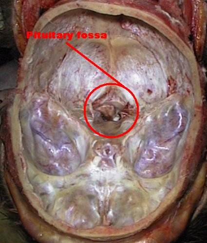 Pituitary fossa