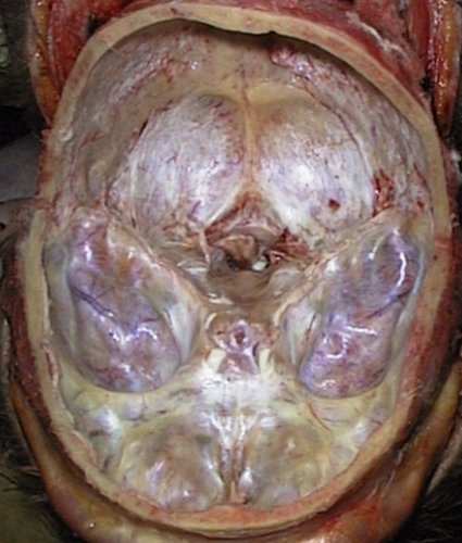 Pituitary fossa
