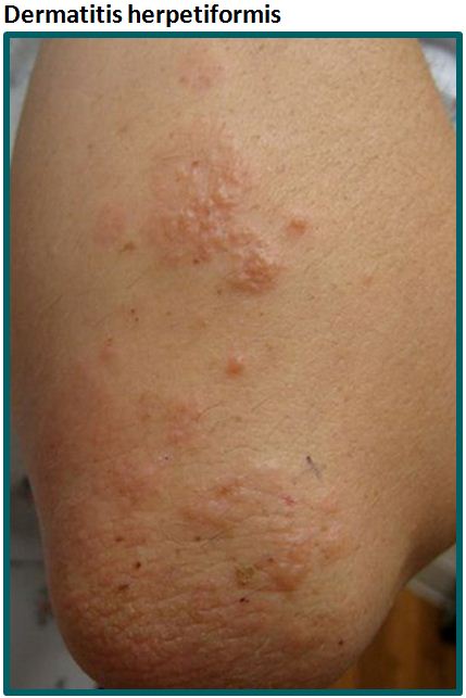 Dermatitis herpetiformis